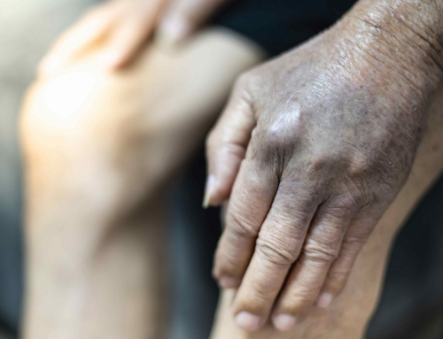 淤青，健康的低声提醒？